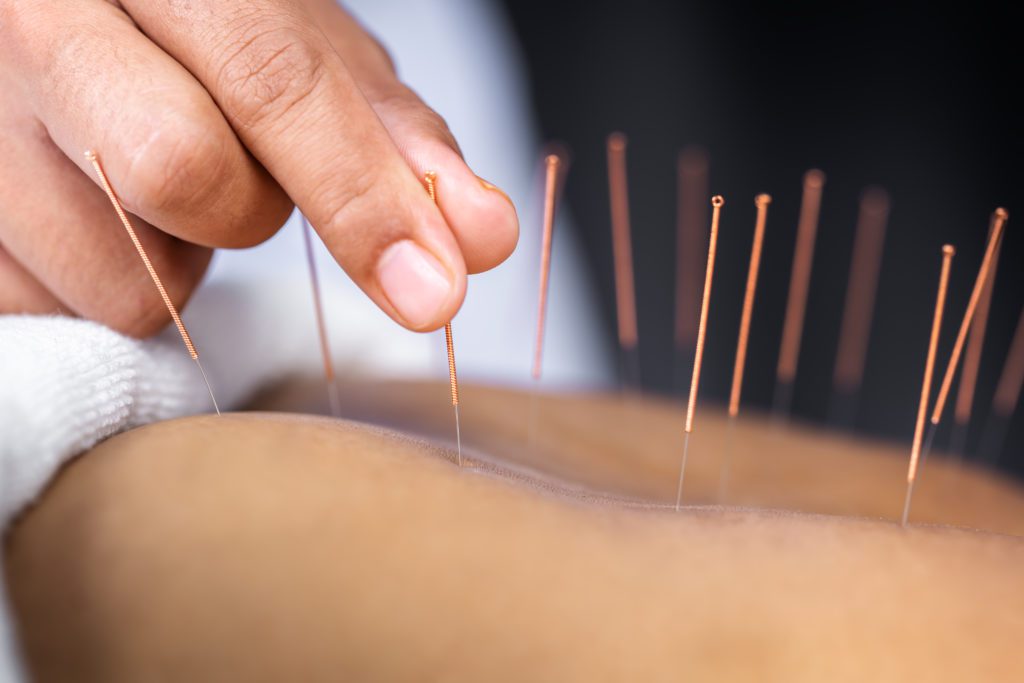 Acupuncture What is It, How it Works, Treatments