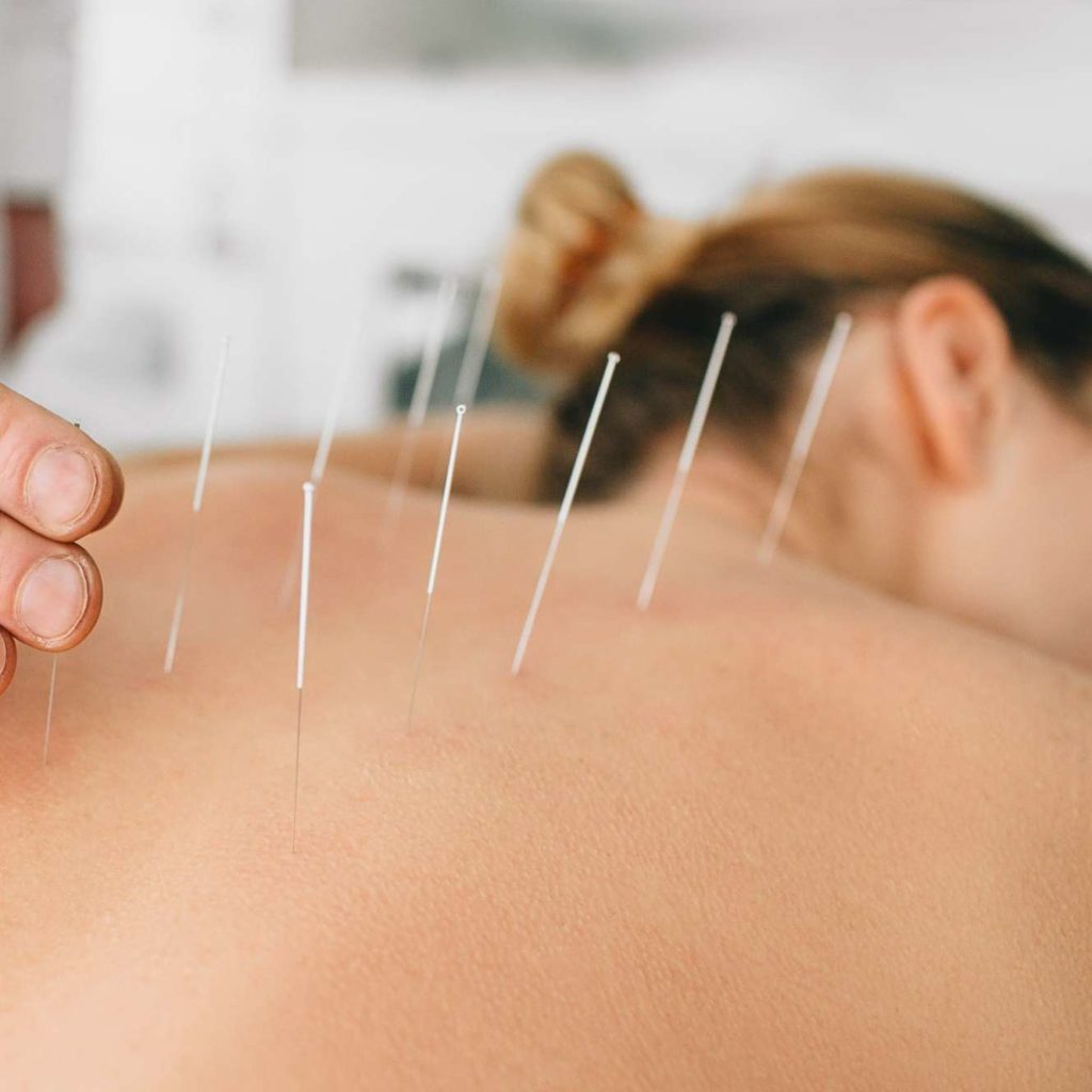 Acupuncture | Botiki Medspa In Ramona, CA